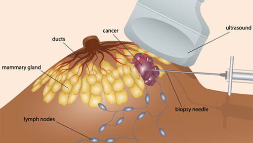 Biopsie Marseille et Mammographie à Marseille